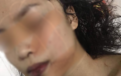 Bắc Ninh: Cô gái 18 tuổi bị bạn cũ lao vào phòng rạch mặt, cổ và tay, phải khâu 60 mũi