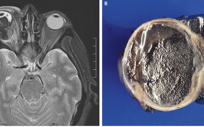 Hóa ra tròng mắt cũng có thể bị ung thư, và những gì xảy đến sau đó sẽ khiến bạn phải giật mình