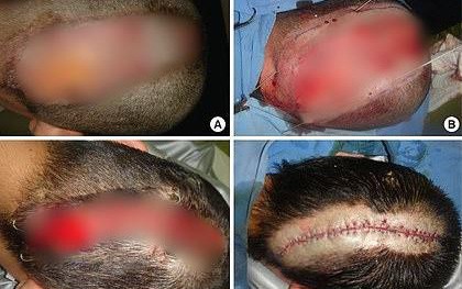Cô gái 21 tuổi bị bỏng da đầu nghiêm trọng, tóc rụng hói nguyên mảng dài sau khi đi nhuộm tóc về