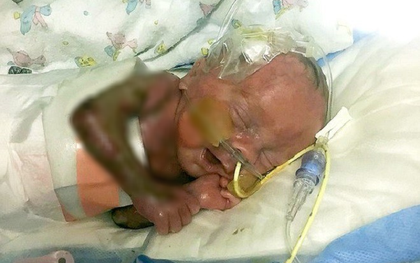 Bé trai sinh ra đã không có da làm nên điều kì diệu khi sống sót sau 6 tháng điều trị