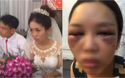 Sự thật bức ảnh cô dâu bị chồng mới cưới đấm sưng phù mặt mũi vì không cho hôn trong clip gây sốt MXH