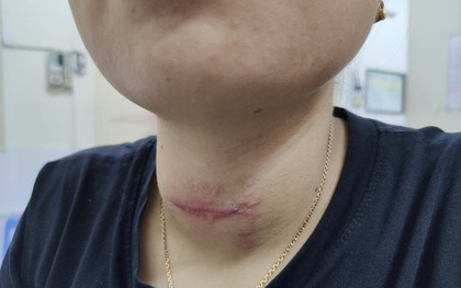 Tự chữa bệnh về tuyến giáp bằng phương pháp "thầy lang", cô gái Hải Phòng bị nhiễm trùng nghiêm trọng vùng cổ