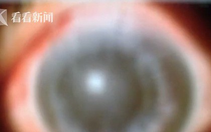 Người phụ nữ bị chảy máu mắt và có nguy cơ mù vĩnh viễn, nguyên nhân hóa ra từ việc đi chợ mua cá sống