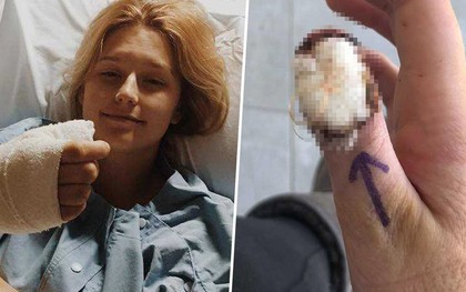 Tâm sự của cô gái bị ung thư, phải cắt bỏ ngón tay cái vì thói quen xấu mà rất nhiều người mắc phải