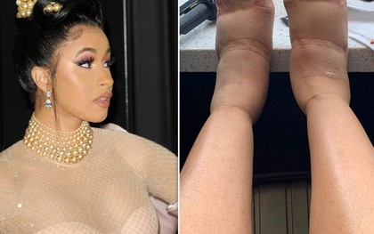 Nữ rapper Cardi B chia sẻ hình ảnh chân sưng phù đáng sợ do tác dụng phụ thường thấy của một phương pháp thẩm mỹ