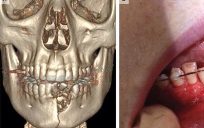 Thuốc lá điện tử phát nổ trong miệng, cậu bé 17 tuổi bay răng, gãy đôi xương hàm