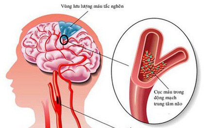 Nắng nóng 41 độ, cảnh báo 7 dấu hiệu sớm của đột quỵ