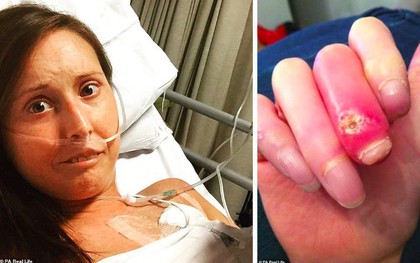 Vì chứng bệnh lạ, cô gái này phải chịu đau đớn cắt đi từng phần ngón tay suốt 6 năm trời
