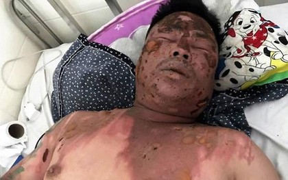 Hỏi tuổi bố bạn nhậu cho dễ xưng hô, người đàn ông bị hất cả nồi lẩu vào mặt gây bỏng nặng