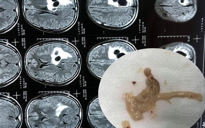 Đau đầu đi cấp cứu phát hiện 5 ổ sán lớn nằm trong não người đàn ông ăn tiết canh