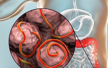 Kinh hãi về loài giun “bò lổn ngổn” quanh hậu môn người và chúng ta dễ bị lây trực tiếp qua quần áo, ga trải giường