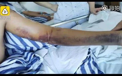 Nam sinh bị gãy tay đau đớn khi cùng bạn thi đấu trò quen thuộc thời đi học nhiều người thích chơi