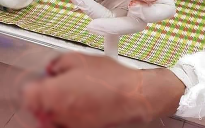 Điện thoại phát nổ 9x bị bỏng nặng khi bỏ chạy vấp vào phích nước sôi