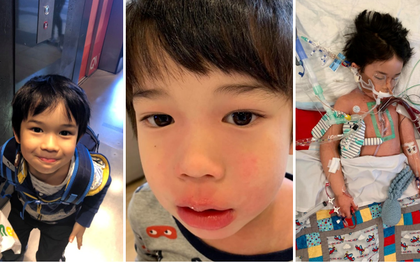 Bé trai 4 tuổi phải nằm viện 6 tháng vì bị nhiễm trùng máu và mắc bệnh do "vi khuẩn ăn thịt", triệu chứng ban đầu chỉ là đau chân