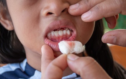 Đột nhiên chảy máu nướu răng hãy làm ngay những việc này để khắc phục