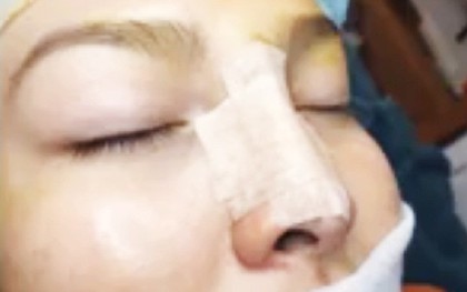 Nghe lời quảng cáo làm đẹp bằng sụn tai, cô gái bị mưng mủ hoại tử nặng vùng mũi