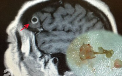 Trong khi tìm kiếm khối u, bác sĩ tìm thấy "vị khách không mời" kinh khủng trong não của một phụ nữ