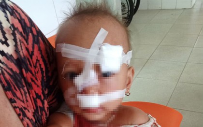 Bố mẹ cãi nhau, bé gái 2 tuổi nhập viện, khâu 12 mũi trên mặt