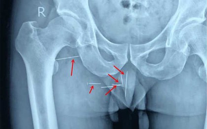 Người đàn ông bị đau ngứa ở mông suốt một thập kỉ, đến bác sĩ kiểm tra mới tá hỏa phát hiện 8 chiếc kim tiêm bị kẹt bên trong