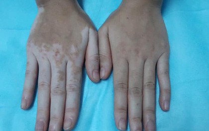 Cô gái bỗng đổi màu da tay, chân sau ngâm lá trầu không