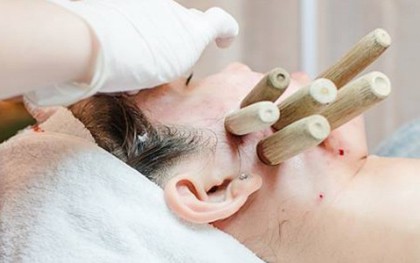 Hút mụn bằng ống tre đang rầm rộ tại các spa: Chuyên gia cảnh báo những ai muốn làm cần chú ý điều này