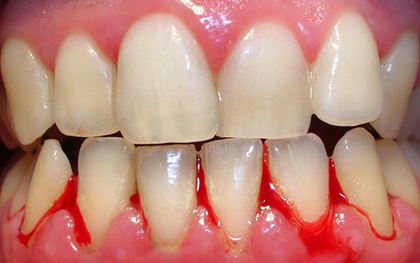 Nếu răng của bạn xuất hiện từ 1 đến 6 triệu chứng sau đây thì bạn cần đi kiểm tra răng càng sớm càng tốt