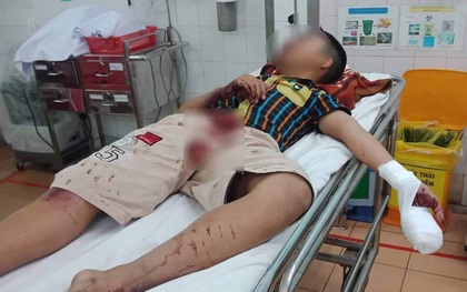 Gia Lai: Làm pháo tự chế bằng bột diêm, nam sinh bị thương nặng