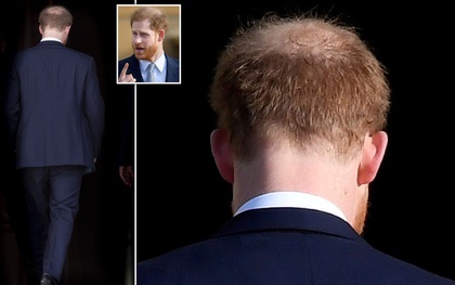 "Nghiệp quật không chừa một ai": Nhiều năm trước trêu chọc anh trai thiếu tóc, Hoàng tử Harry giờ cũng đã có dấu hiệu bị hói đầu