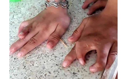 Một dòng họ ở Tiền Giang bị dị tật "càng cua" hiếm gặp