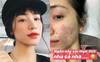 Ngày thường makeup kĩ càng, chỉnh ảnh lung linh nên ít ai ngờ Hòa Minzy cũng có “cả rổ” mụn thịt