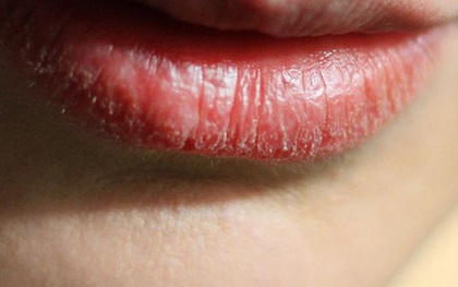 Bong tróc môi có thể là dấu hiệu cảnh báo những vấn đề sức khỏe nghiêm trọng hơn bạn tưởng