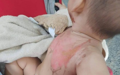Bị nước sôi đổ lên người, bé trai 2 tuổi bỏng nặng
