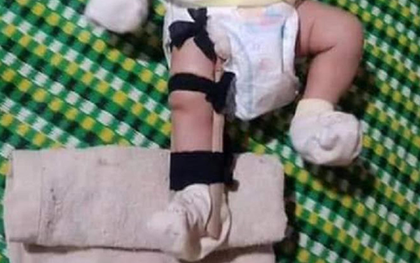 Cháu bé 2 tháng tuổi nghi bị cha ruột đánh gãy chân