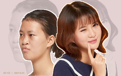 Cô gái hở hàm ếch "lột xác" xinh đẹp sau thẩm mỹ: "Tôi từng nghĩ hay là mình chết đi để bố mẹ không phải lo lắng, tìm chỗ phẫu thuật miễn phí cho mình"