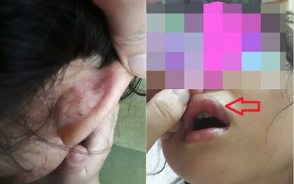 Hà Nội: Cô giáo tiểu học bị tố dùng tay, sách đánh học sinh chảy máu, dập môi tại trường học