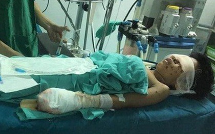 Thiếu niên bị nát tay, vỡ nhãn cầu cả 2 mắt sau tiếng nổ lớn