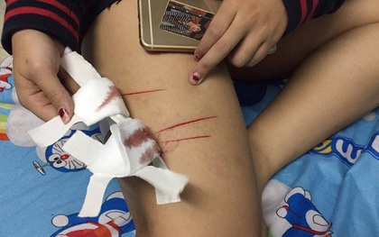 Nữ sinh ở TPHCM bị rạch đùi gây thương tích trên đường đi học về