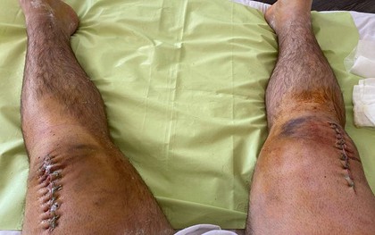 Gãy cả 2 chân vì squat 400 kg, VĐV cử tạ đăng ảnh đầu gối chi chít những mũi khâu