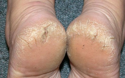 Luôn cảm thấy gót chân bị khô và nứt nẻ: 4 "thủ phạm" là nguyên nhân gây ra vấn đề này nhưng nhiều người không biết