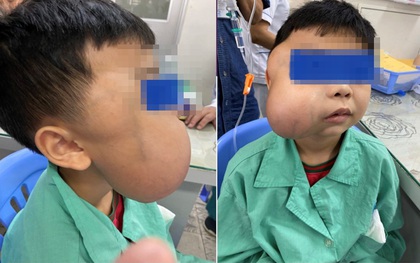 Khối u làm biến dạng khuôn mặt bé trai 13 tuổi lần đầu phát hiện ở Việt Nam