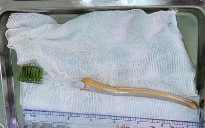 Bé trai 13 tuổi suýt chết vì nuốt bàn chải đánh răng vào bụng