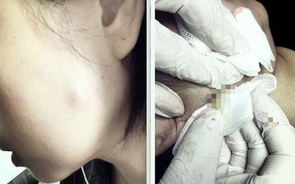 Tiêm botox làm đẹp, người phụ nữ 30 tuổi phải nhập viện