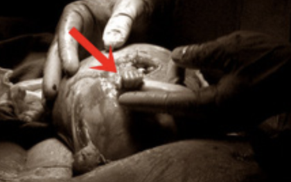 20 năm sau khoảnh khắc ấn tượng, thai nhi 21 tuần tuổi trong bức ảnh thò tay ra khỏi tử cung mẹ nắm chặt ngón tay bác sĩ giờ ra sao?