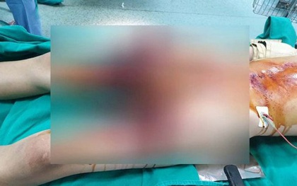 Học chế tạo pháo trên mạng, nam sinh 13 tuổi dập nát bàn tay