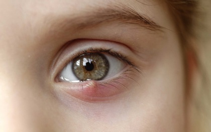 8 dấu hiệu cảnh báo bệnh tật được “khắc” rất rõ trên mắt: Ai cũng cần đọc để đối chiếu với sức khỏe bản thân