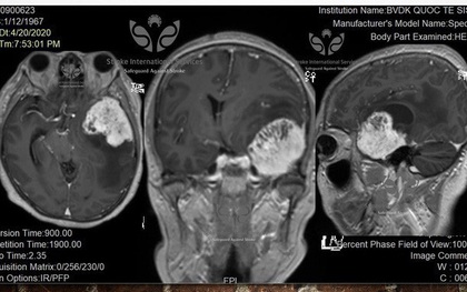Hy hữu: Bác sĩ mắc u não khổng lồ vẫn làm việc bình thường