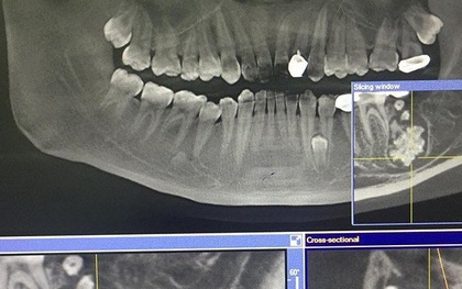 Nam thanh niên ở Hà Nội có khối u lạ chứa nhiều răng nhỏ trong miệng