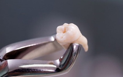 Nhổ 20 chiếc răng cùng lúc, người phụ nữ hôn mê trong 9 ngày rồi tử vong