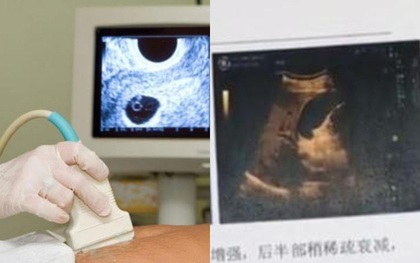 Đi siêu âm vì đau bụng, người đàn ông hoảng loạn tột cùng khi biết mình có thai nhưng ngay lập tức thở phào vì lời giải thích của bác sĩ