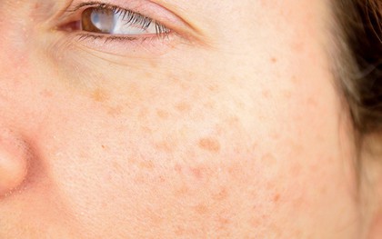 Cơ thể có quá nhiều “rác” sẽ xuất hiện 5 triệu chứng “tiên tri”: Đáng tiếc điều số 2 thường dễ bị nhầm lẫn